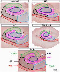 1 metre is equal to 1000 mm, or 2834.6456692913 pt. Disease Related Microglia Heterogeneity In The Hippocampus Of Alzheimer S Disease Dementia With Lewy Bodies And Hippocampal Sclerosis Of Aging Acta Neuropathologica Communications Full Text