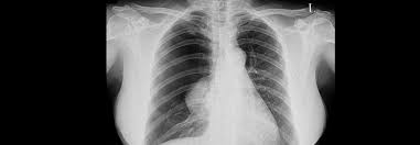 What is pneumothorax (collapsed lung)? Abwarten Als Neue Option Beim Spontanpneumothorax Medical Tribune