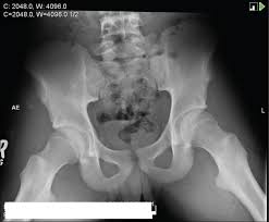 Teenagers are more likely to have this injury than younger children. Clinmed International Library