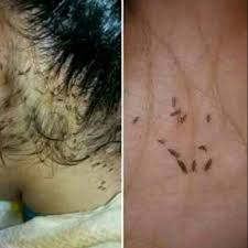Baik kutu rambut kepala atau kutu rambut kemaluan biasanya timbul ketika seseorang kurang kutu yang tumbuh di rambut memiliki ukuran yang sangat kecil. Ubat Kutu Rambut Organik Tanpa Racun Shopee Malaysia