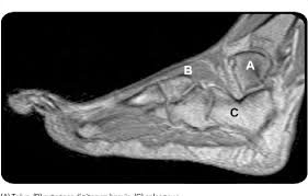 Lumbricals of foot are multiple small muscles that contribute biomechanical balance of the foot during walking. Figure 1 From Muscle Histology Vs Mri In Duchenne Muscular Dystrophy Semantic Scholar