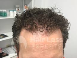 Drkingsley february 18, 2016 hair loss, news. Home Hair Loss Experts