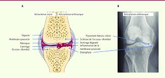 L'arthrose est une maladie des articulations qui provoque la dégradation du cartilage, la prolifération osseuse ou la formation de kystes dans les os. Diagnostic De L Arthrose Du Genou A Schema Representatif D Une Download Scientific Diagram