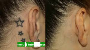 For questions or comments, please use the information listed here. Tattoo Removal Numbing Cream By Erazelaser Clinic