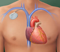It sends a larger electrical shock to the heart that essentially reboots it to get it pumping again. Pacemaker Icd Implantable Cardioverter Defibrillator Citrus Cardiology Consultants Pa
