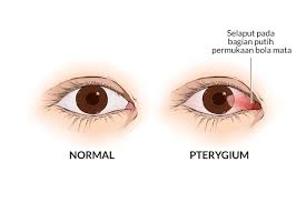 Namun terkadang, kondisi ini bisa menjadi masalah yang mengganggu aktivitas dan rasa nyaman sehingga membutuhkan penanganan khusus. Pterygium Gejala Penyebab Dan Mengobati Alodokter