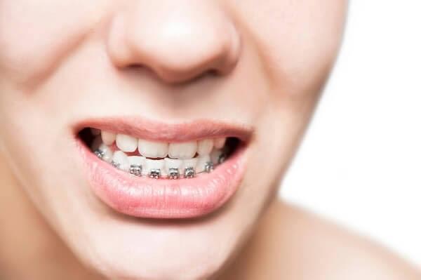 hàm răng dưới không đều
