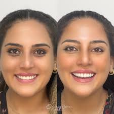 Detrás de cada sonrisa hay una historia✨ Hoy te muestro el cambio que  logramos con 6 carillas de resina, diseñadas para resaltar su belleza  natural y devolverle seguridad al sonreír 🤩
