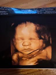 Miracles Happen 3D/4D/HD Ultrasound