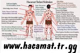 Vucutta Hacamat Noktalari Google Da Ara Hijama Medical Knowledge Alternative Medicine
