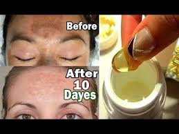 I Apply Vitamin E Oil On My Face Look What Happened Crystal Clear Skin Spotless Skin Dark Spots You Dark Spots On Skin Dark Patches On Skin Vitamin E Oil