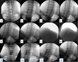 Image result for Lower Cervical Intramuscular Injection