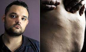 Dercum S Disease Sufferer Who S Covered In Hundreds Of Balls Of Fat Daily Mail Online