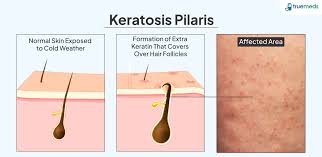 Image result for Keratosis pilaris