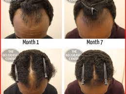 Another big cause of hair conditions like hair loss in women is pregnancy related and in this case women may temporarily lose some hair during pregnancy or immediately after birth. Teenage Male Pattern Baldness Check More At Https Www Bestkidshairstyle Com Teenage Male Pattern Baldn Kids Hairstyles Male Pattern Baldness Pattern Baldness