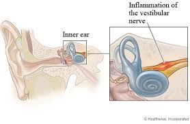 Image result for Bacterial Labyrinthitis