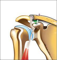 Magdy said to simplify the anatomical features of the. All Arthroscopic Augmented Vargas Procedure An Option After Failed Acromioclavicular Joint Dislocation Reconstruction A Technical Note Sciencedirect