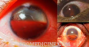 Image result for Hyphema