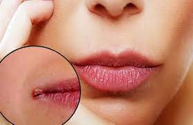 Rinse the lip with cold water and check whether any areas are cut and not just bruised. 12 Home Remedies To Heal Cracked Lip Corners Fast That Really Work