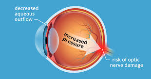 ocular hypertension 5 causes of high eye pressure