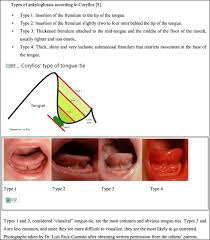 Image result for Ankyloglossia