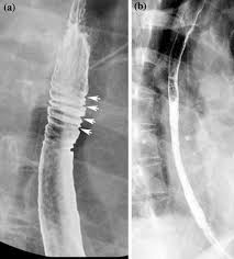 Timmers hjlm, chen cc, carrasquillo ja, et al. History And Evolution Of The Barium Swallow For Evaluation Of The Pharynx And Esophagus Springerlink