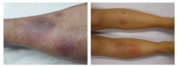 Image result for erythema nodosum