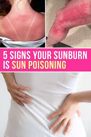 We did not find results for: Family Magazine Signs Of Sun Poisoning