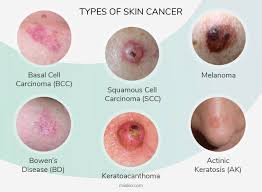 Image result for skin cancer on nose pimple