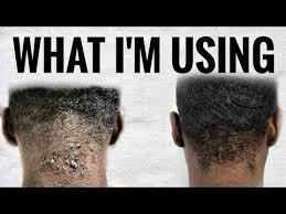 Explore a wide range of the best bump hair on aliexpress to find one that suits you! Curing The Bumps On The Back Of My Neck Acne Keloidalis Nuchae Youtube