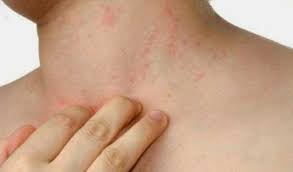 Jangkitan kulat pada kulit boleh mempunyai gejala yang sangat serupa dengan keadaan kulit yang lain, seperti dermatitis seborrheic, psoriasis, dermatitis atopik, dermatitis kontak, atau bahkan penyakit lyme. Ulog Day 01 Penyebab Gatal Gatal Kulit Dan Bintik Bintik Kecil Steemit