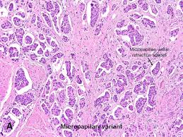 Urothelial Carcinoma Variants American Urological Association