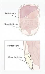 Swelling of the peritoneal cavity; Peritoneal Mesothelioma Also Known As Abdominal Mesothelioma Is Typically The Result Of Prolonged Airborne Asbestos Exposure Mesothelioma Abdominal Cancer