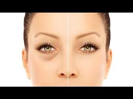 Check spelling or type a new query. How To Get Rid Of Puffy Eyes From Crying 6 Best And Natural Methods Youtube