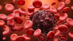 Image result for Hematologic Cancer