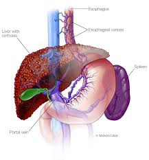 Image result for blood in stool human poop