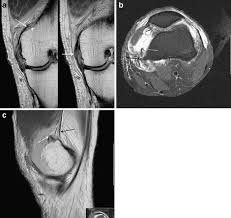 Most of the cases of pellegrini stieda lesions are not symptomatic, and pellegrini stieda syndrome is said to exist when the lesion becomes symptomatic i.e. New Thoughts On The Origin Of Pellegrini Stieda The Association Of Pcl Injury And Medial Femoral Epicondylar Periosteal Stripping Springerlink