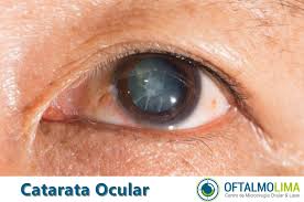 Poor vision caused by cataracts may also resu. Catarata Ocular Sintomas Causas Y Tratamiento Oftalmolima Catarata Ocular