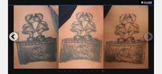 Tattoo Removal Using Cutera Enlighten Laser Tattooremoval