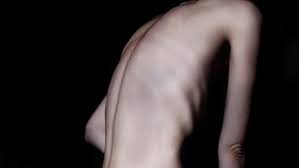 Los anoréxicos tienen un miedo intenso a engordar y perder el control de su figura corporal. Investigadores Aconsejan Combinar La Terapia Cognitivo Conductual Y La Realidad Virtual Para Tratar La Anorexia Nerviosa