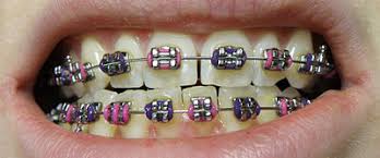How long does it take for damon braces to work. Dental Braces Wikipedia