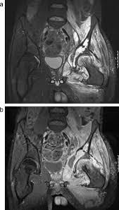 If you are concerned about any changes you experience, please talk with your doctor. Bone And Soft Tissue Tumors Of Hip And Pelvis Sciencedirect