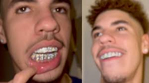 But there was some ugliness. Lamelo Ball Ices Out His Mouth With 14k Gold Diamond Grill After Signing His Hornets Contract Youtube
