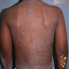 Image result for chickenpox