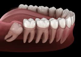 Dentista em Santos explica: Quando é necessário remover os dentes do siso?