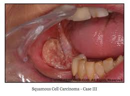 Image result for spinocellular carcinoma of the oral cavity