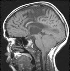 Chiari Ii