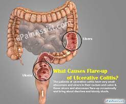 See full list on wikihow.com What Causes Flare Up Of Ulcerative Colitis How To Ease It