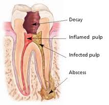 Root Canal And Root Canal Retreatment Endodontist