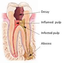 If left untreated, the bacteria will multiply, eroding the bone and affecting the surrounding gums. Root Canal And Root Canal Retreatment Endodontist